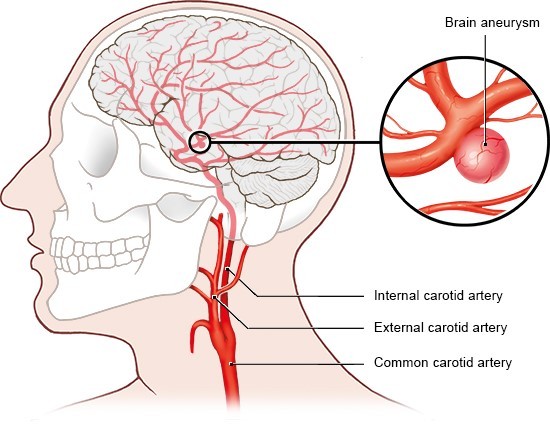 What is  brain aneurysm?