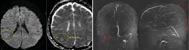 Cisplatin induced cerebral sinus venous thrombosis in cervical cancer patients treated with concurrent chemoradiation: a case series