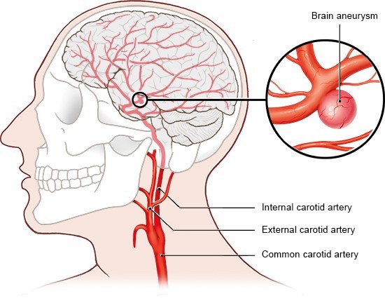 What is a brain aneurysm?